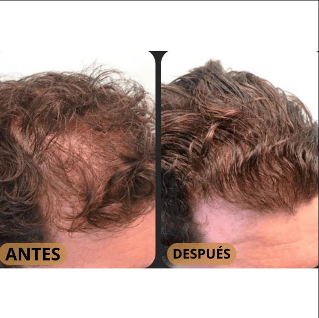 CLEVIRA TITAN™ Champú Activador de Raíces para Hombres contra la Caída del Cabello – Mayor crecimiento del cabello con solo 4 lavados a la semana