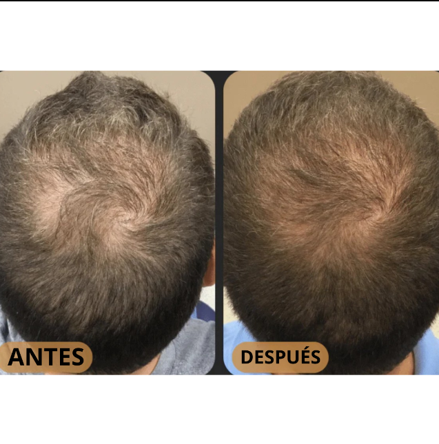 CLEVIRA TITAN™ Champú Activador de Raíces para Hombres contra la Caída del Cabello – Mayor crecimiento del cabello con solo 4 lavados a la semana