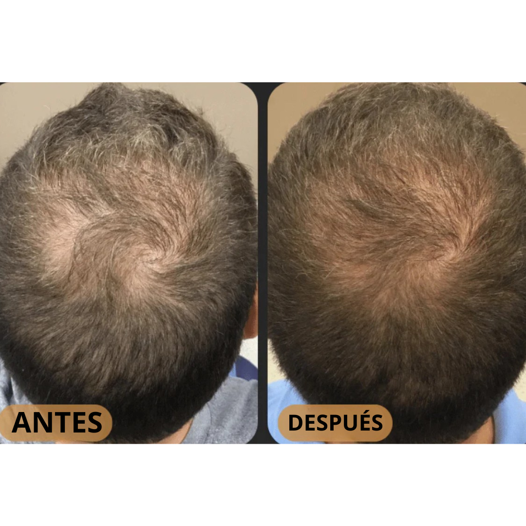 CLEVIRA TITAN™ Champú Activador de Raíces para Hombres contra la Caída del Cabello – Mayor crecimiento del cabello con solo 4 lavados a la semana